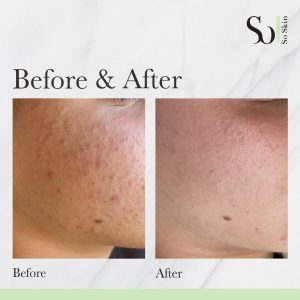 B&A 3