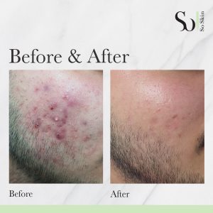 B&A 6